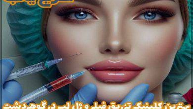 بهترین کلینیک تزریق فیلر و ژل لب در گوهردشت