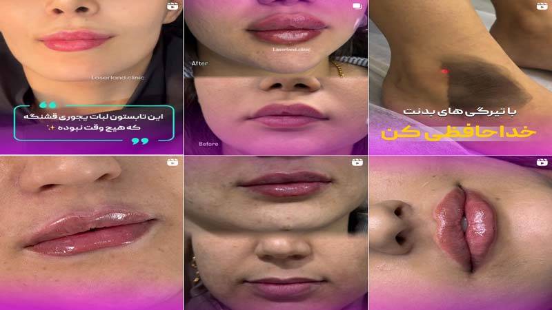 اینستاگرام مرکز لیزر لیزرلند