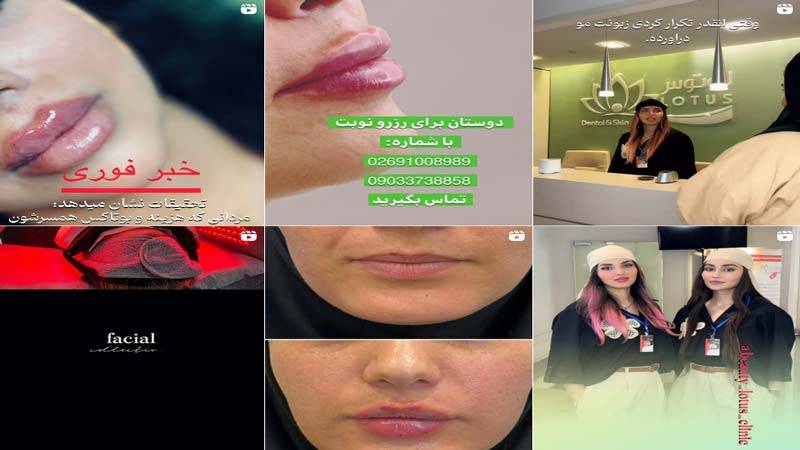 اینستاگرام کلینیک زیبایی لوتوس